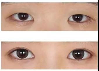 我只是想做个双眼皮,为什么还要让我开眼角?