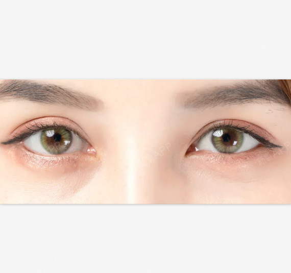 导致失明: 干眼症如果没有及时进行治疗,眼器官就会发生变化,眼结角膜