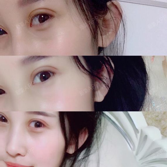 切开双眼皮一般在5-7天拆线,15-20天左右基本消肿, 3-6个月完全恢复