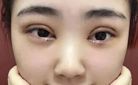 五张图告诉你,什么样的双眼皮适合你!