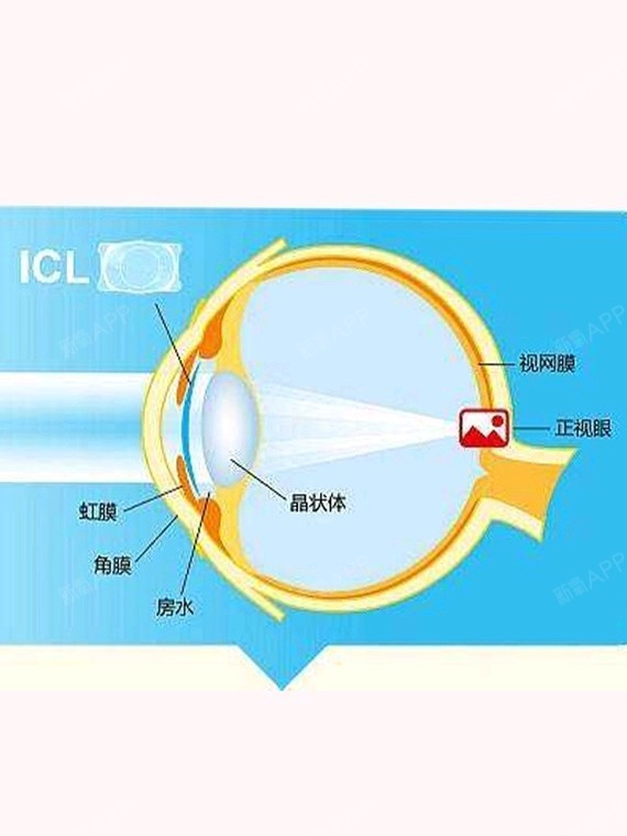 近距离揭秘近视眼手术类型与过程