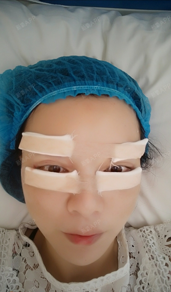 今天去做了去眼袋和提眉手术,提眉是本身去鱼尾纹比较