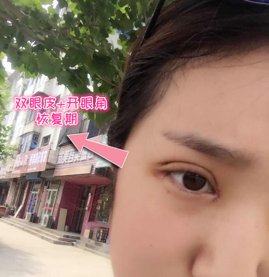 为什么大部分人开眼角后反而变丑了