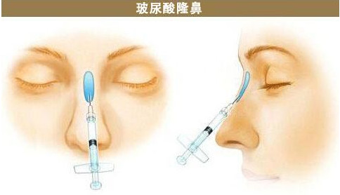 【广州紫馨-于晓强】注射玻尿酸隆鼻会不会变形,影响面部表情呢?