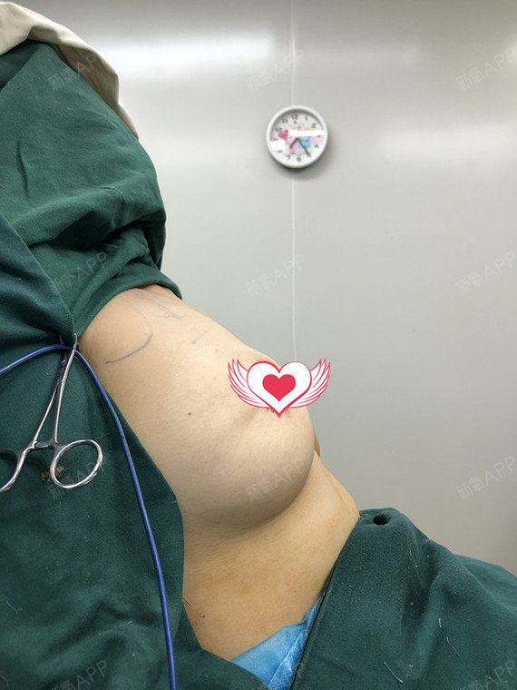 乳房下垂矫正