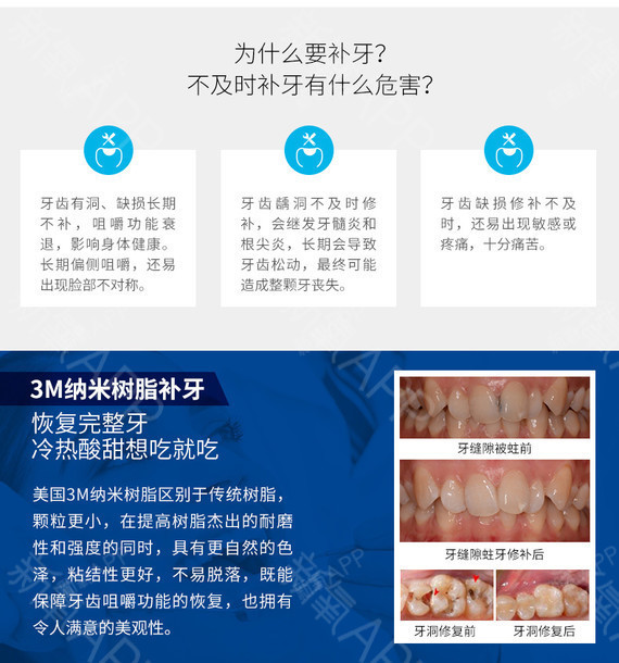 【补牙】美国3m纳米树脂补牙 修补牙齿缺损/牙洞/龋齿/蛀牙 坚固耐磨