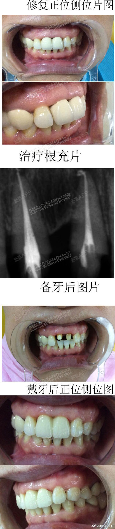 叩( —)   诊断: 11 21 慢性牙髓炎  计划: 11 21根管治疗后全瓷冠
