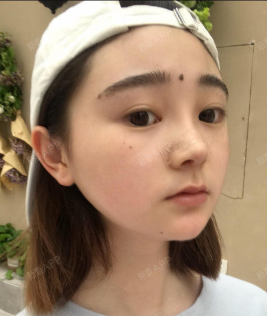 肋软骨隆鼻