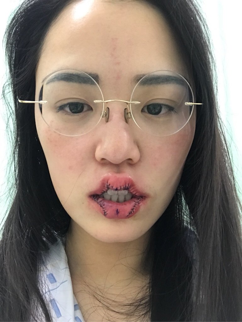 m唇手术第2天