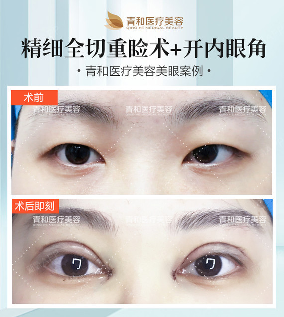 到底,要不要开内眼角?是啊,为什么要开眼_圈子-新氧