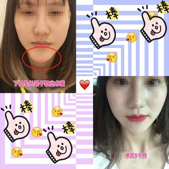 下巴生长因子取出前后的经历!