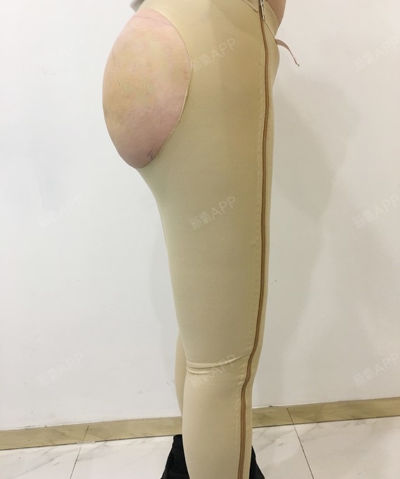 因为自己瘦所以胸不大,屁股也很扁,做丰胸的时候医生