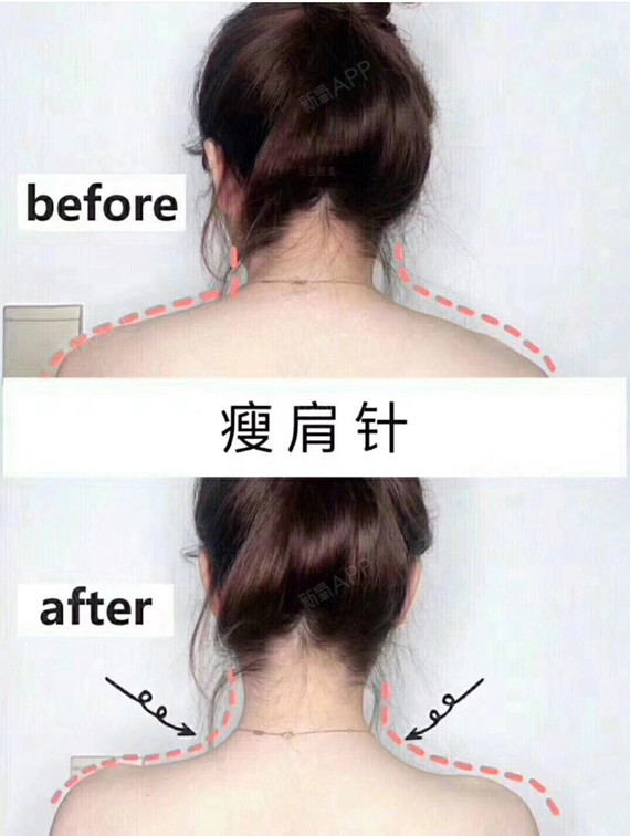 注射瘦肩肌