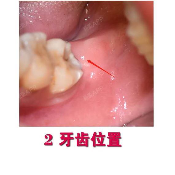 薄而锋利的工作端使得它能够压缩牙槽骨,切断牙周膜,轻柔的拔除牙齿