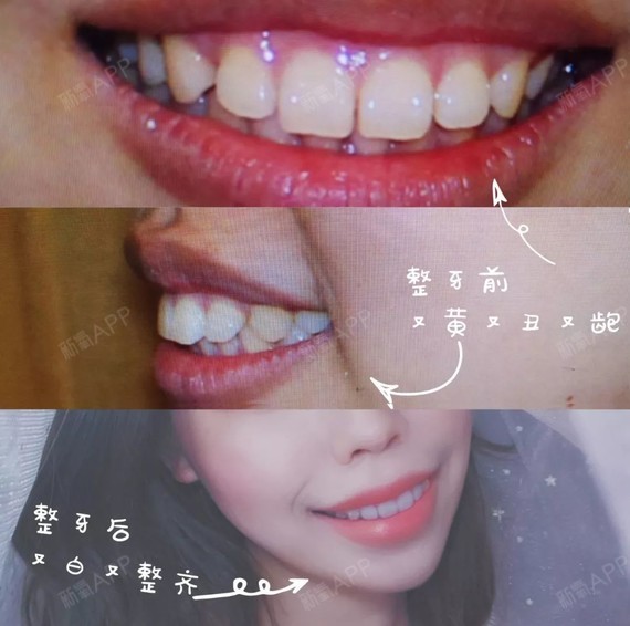 矫正前与矫正后的牙齿对比