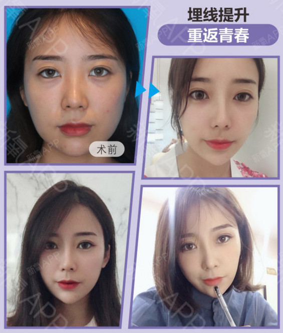 但线雕因其能让人得到瞬间提升的即刻效果,且恢复期短,被越来越多的