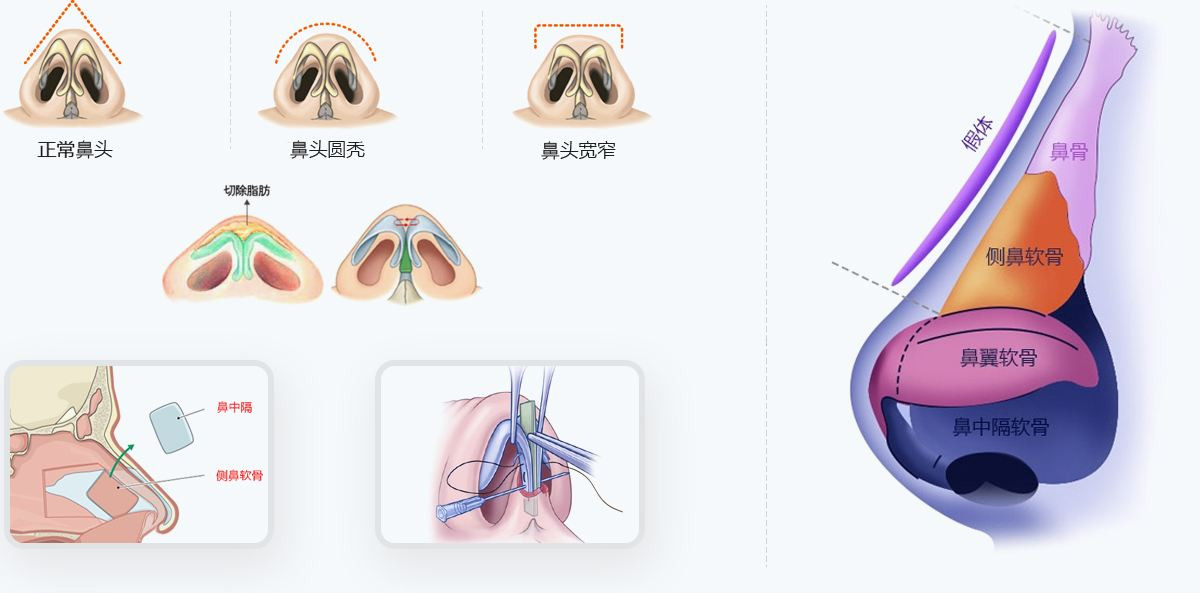 像上述所说如果自身鼻部条件差的话,又怕透光,如果真的没有办法避免