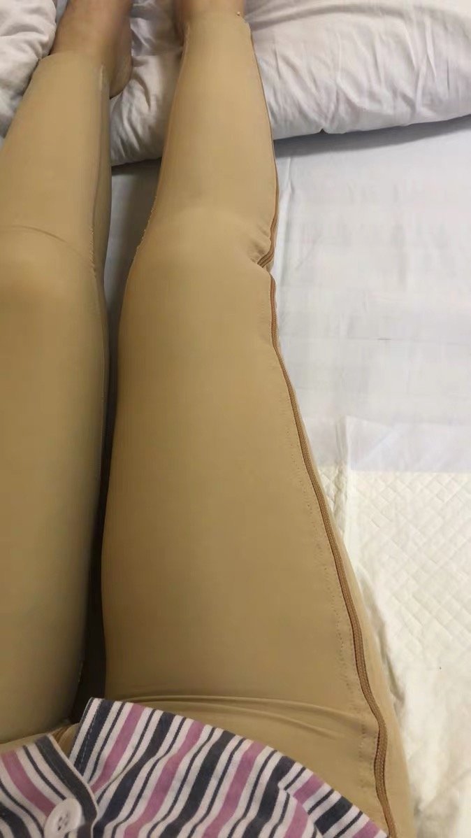 吸脂瘦全身第7天
