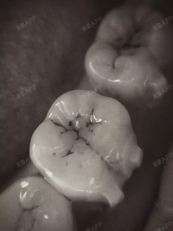 后磨牙的缝隙?