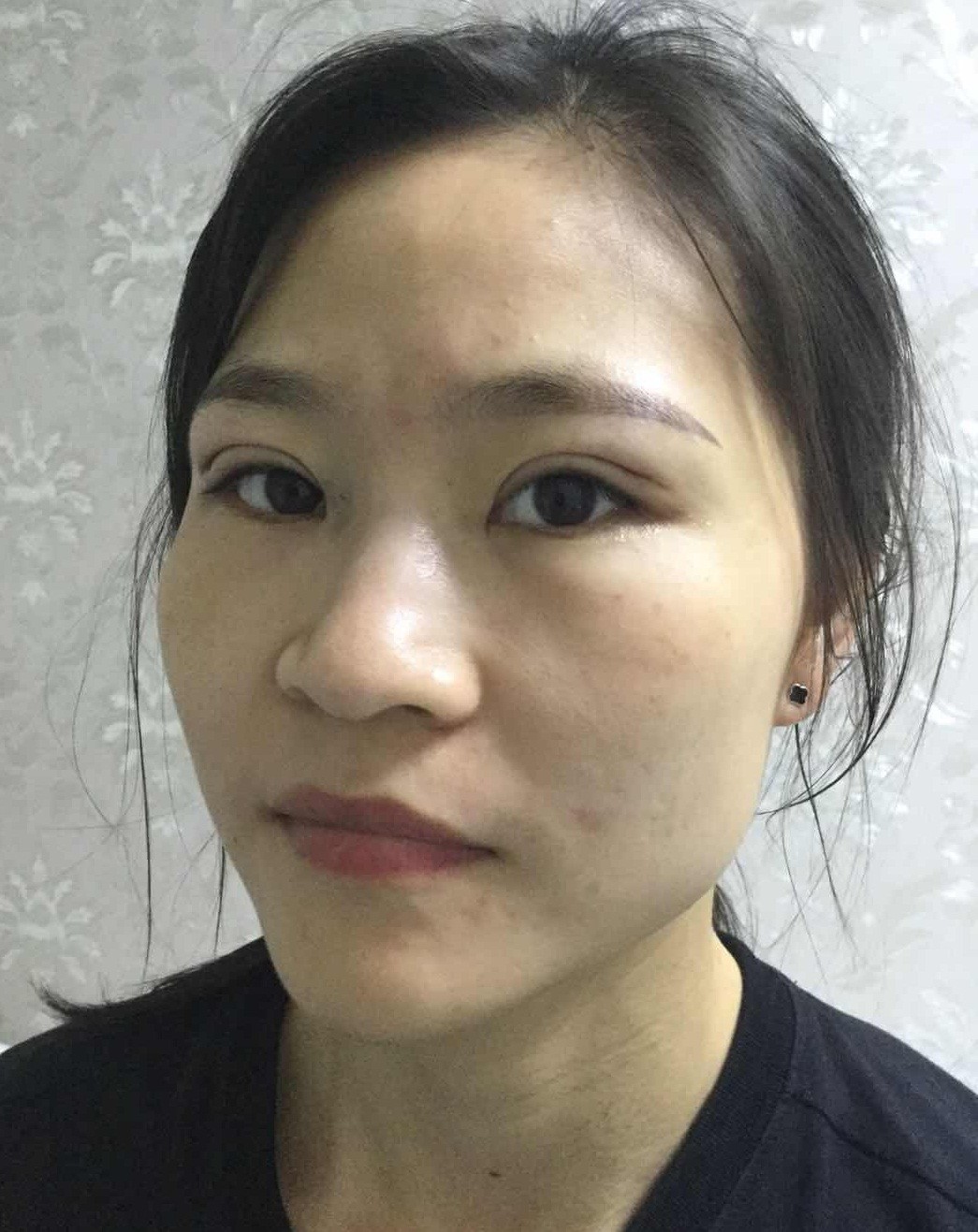 严重肿胀期定点双眼皮第 天           ·           第1篇日记