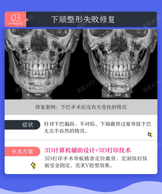 【下颌角整形】颌面整形失败修复 【3d定制】人工骨颌面修复/下颌角