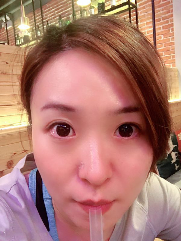埋线双眼皮第25天