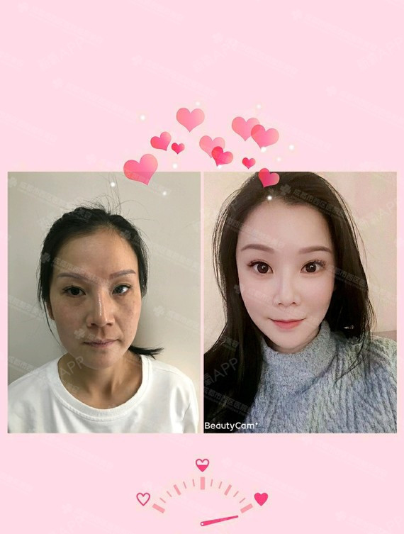 自体脂肪填充全脸