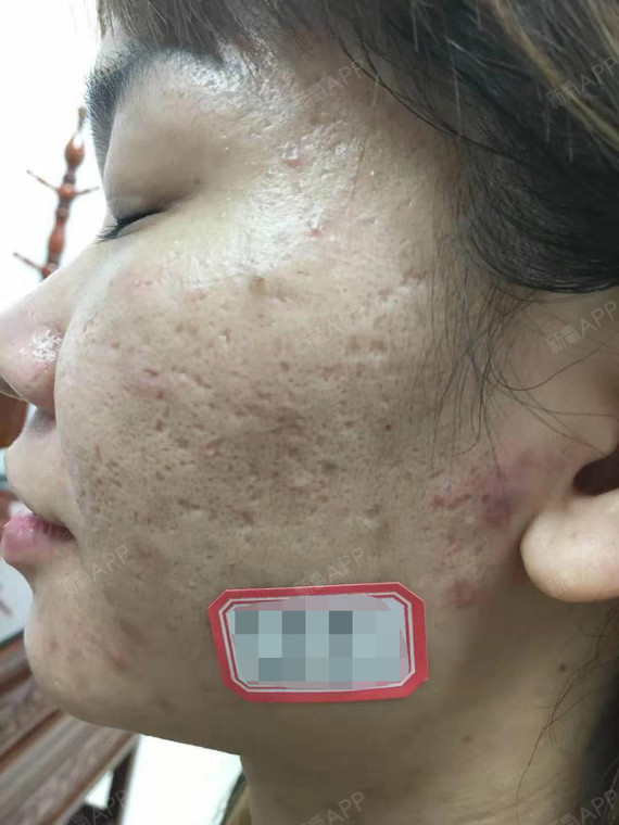 脸上坑坑洼洼太多了,都是以前不懂事有痘痘就挤掉,现_圈子-新氧美容