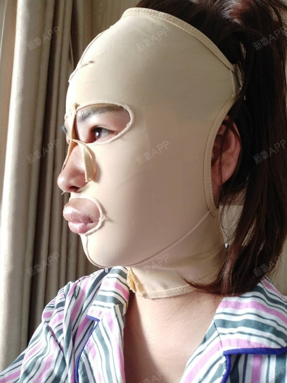 感觉这几天下来好多了,就是嘴还是有点肿,这个绷带确实勒得挺