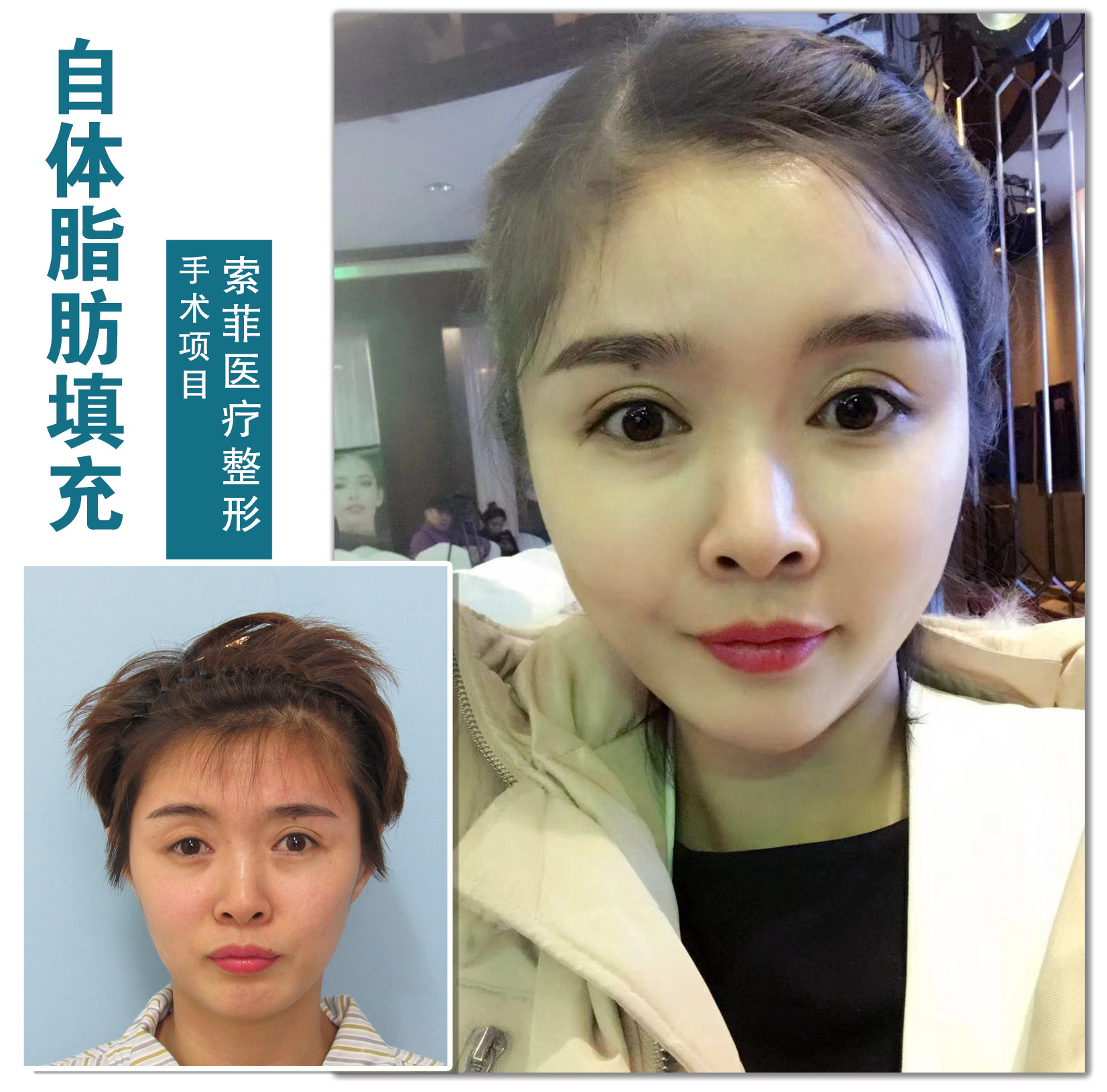 自体脂肪泪沟填充手术最重要的是什么?