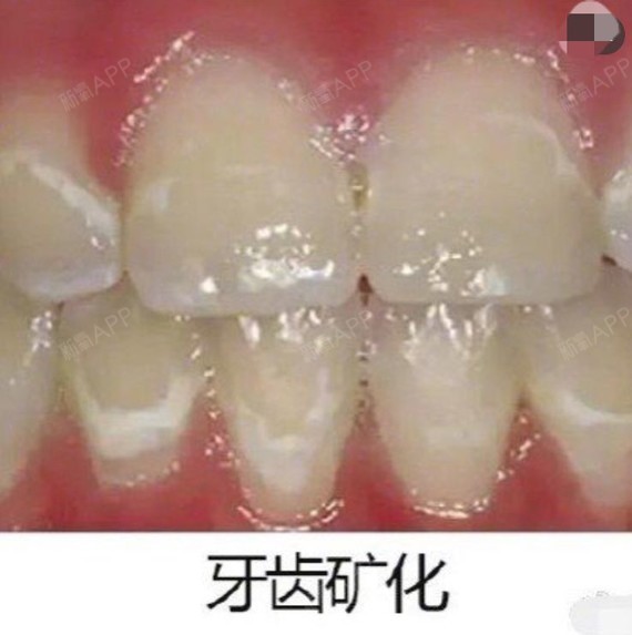 脱矿—牙齿上这个小白点是什么