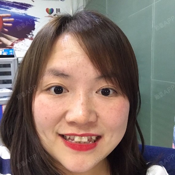 正畸是否需要拔牙牙齿不拔牙矫正带牙套到现在为止已经_圈子-新氧美容
