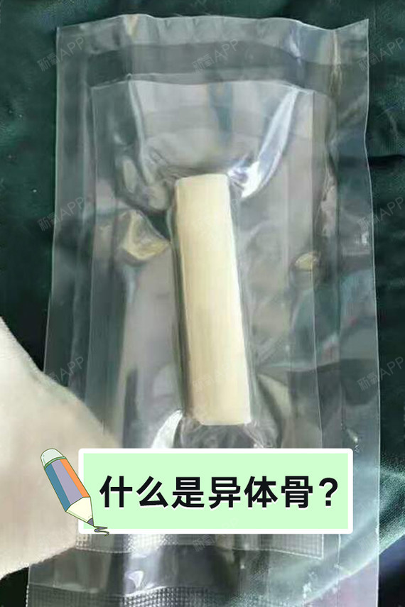 什么是异体骨