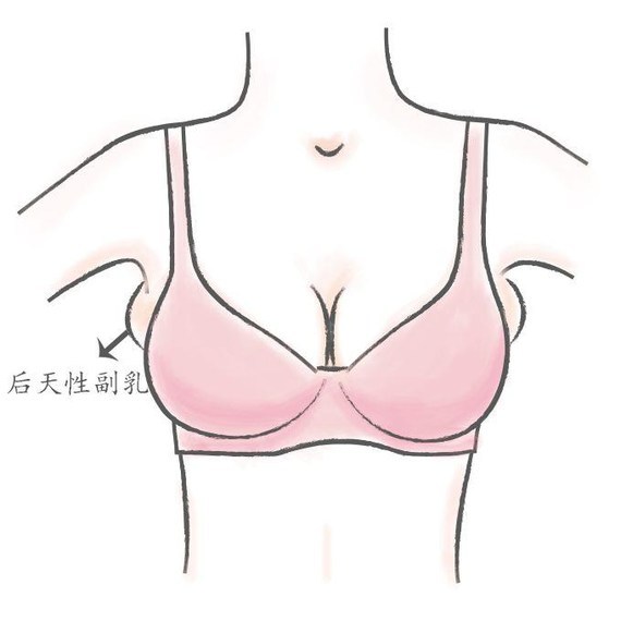 副乳分为后天型和先天型 后天型副乳又称为假性副乳 这