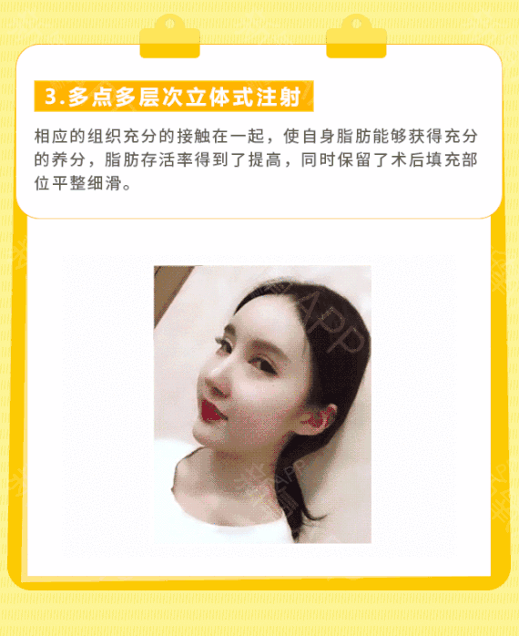 法令纹1个,填充其他部位请咨询我们的客服mm哟 【无套路 真技术】