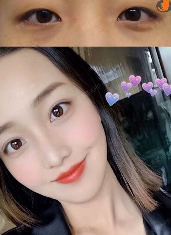美女之前眼睛是内双加上眼皮松弛