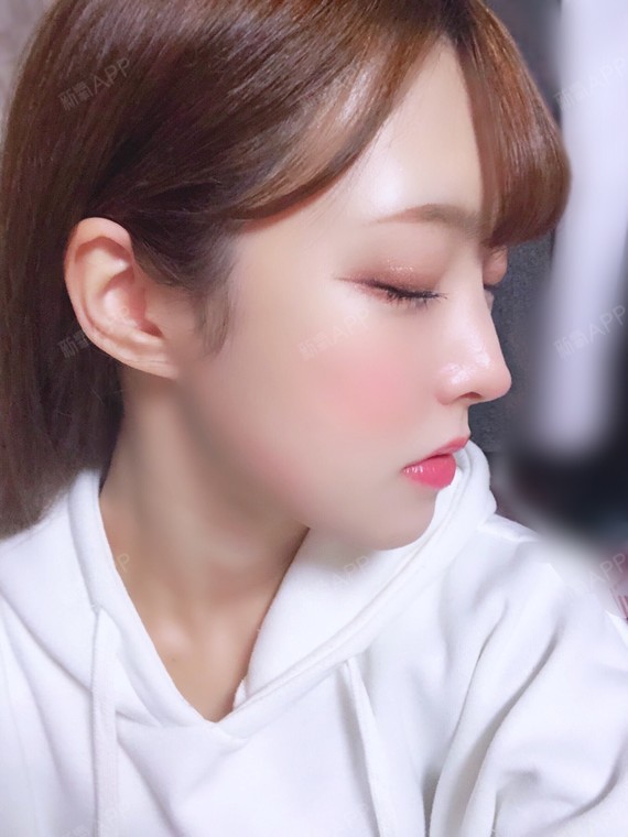 v-line瓜子脸手术好不好_效果图_麻麻米娅v-line瓜子脸手术术后第303