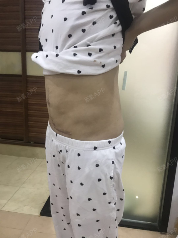 腹壁成形术好不好_效果图_爱喝茶儿腹壁成形术术后第