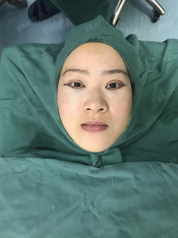 刚做完护士给我拍了个照片,效果还挺明显的,就希望术后疤痕能恢复好一