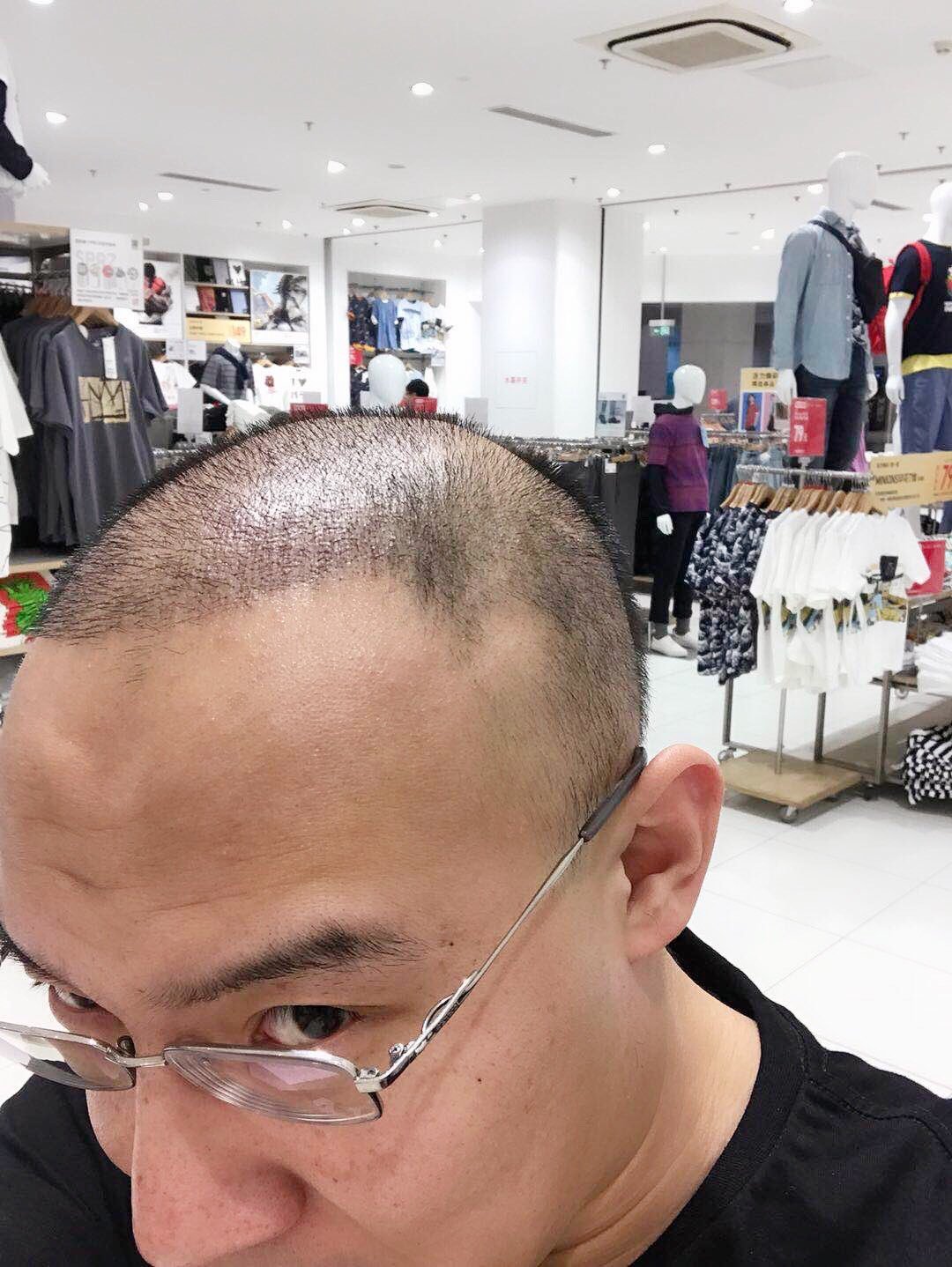 今天是我植发的第50天,头发已经跟我自己的融合子一起,不仔细看,就不