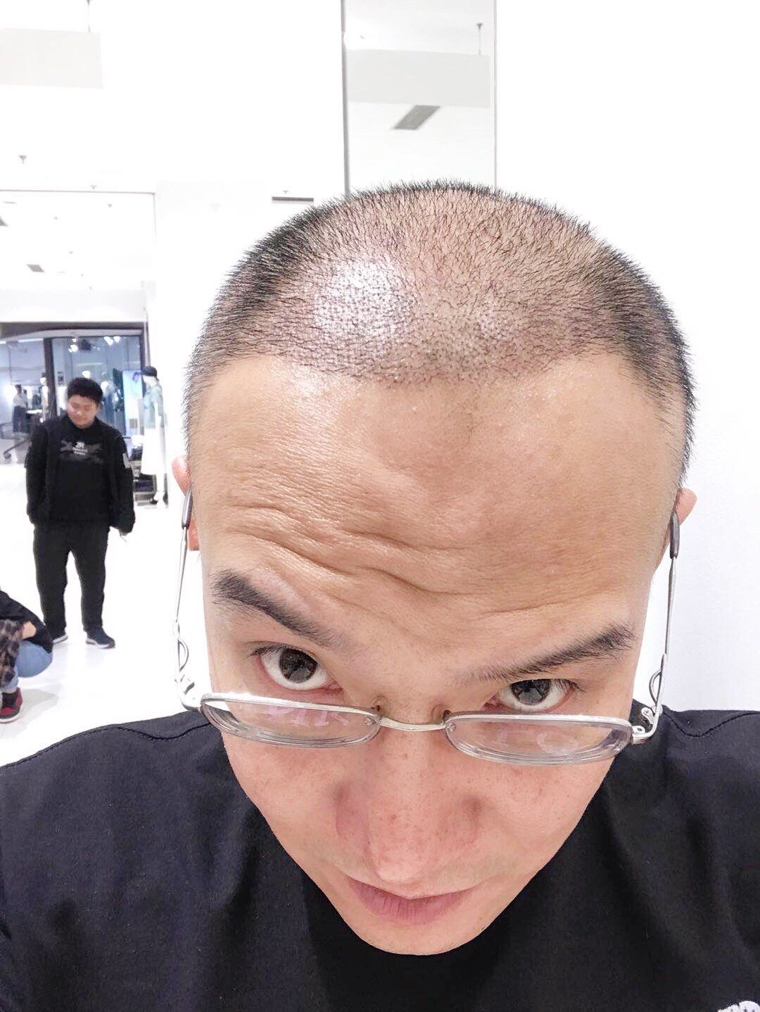 今天是我植发的第50天,头发已经跟我自己的融合子一起,不仔细看,就不