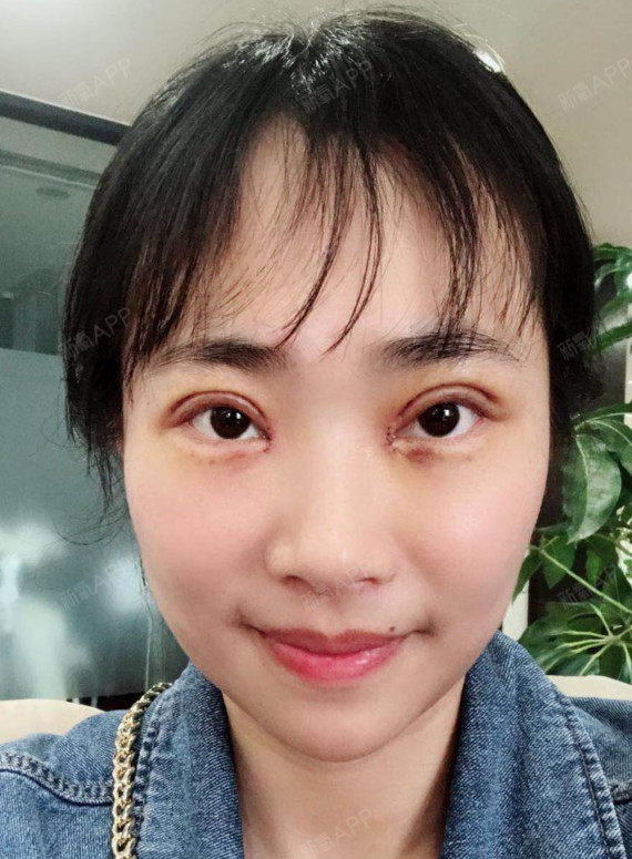 双眼皮术后五天,假性肉条明显