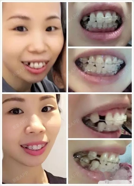 2015年9月上牙套这是收缝隙3个月的对比图