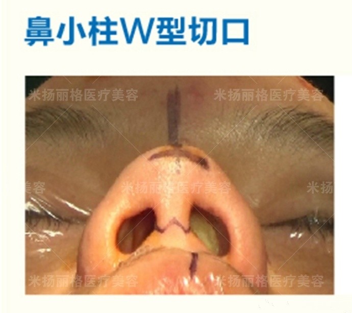 做鼻综合一起做垫鼻基底,还用在口腔内开口吗?