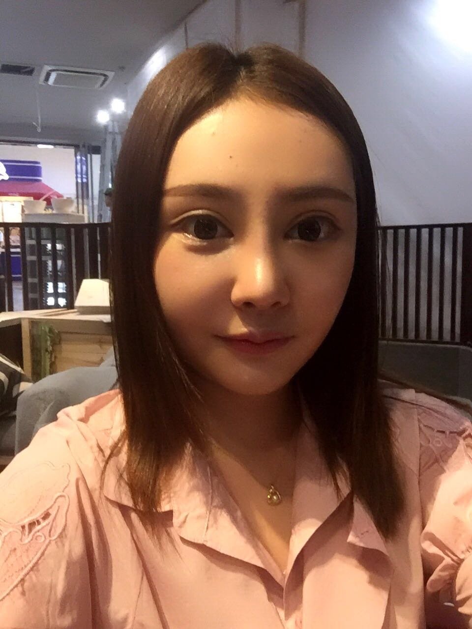 鼻综合怎么样_前后对比图_过程_你别管我整形日记9.20