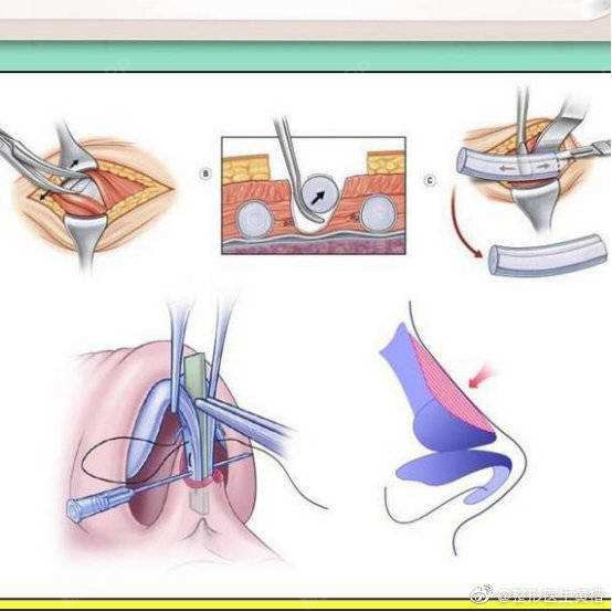 【自体肋软骨隆鼻会出现包膜挛缩?】