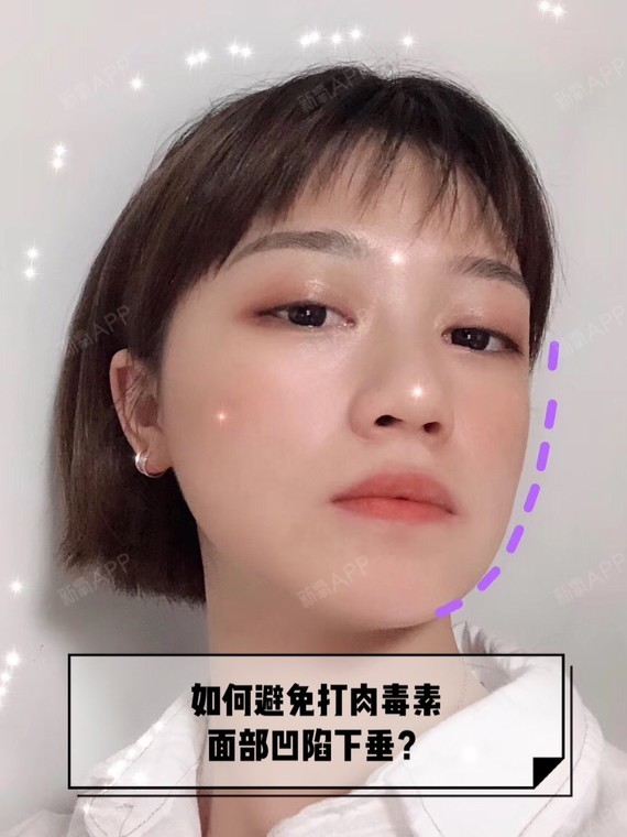 如何避免打肉毒素面部凹陷下垂?