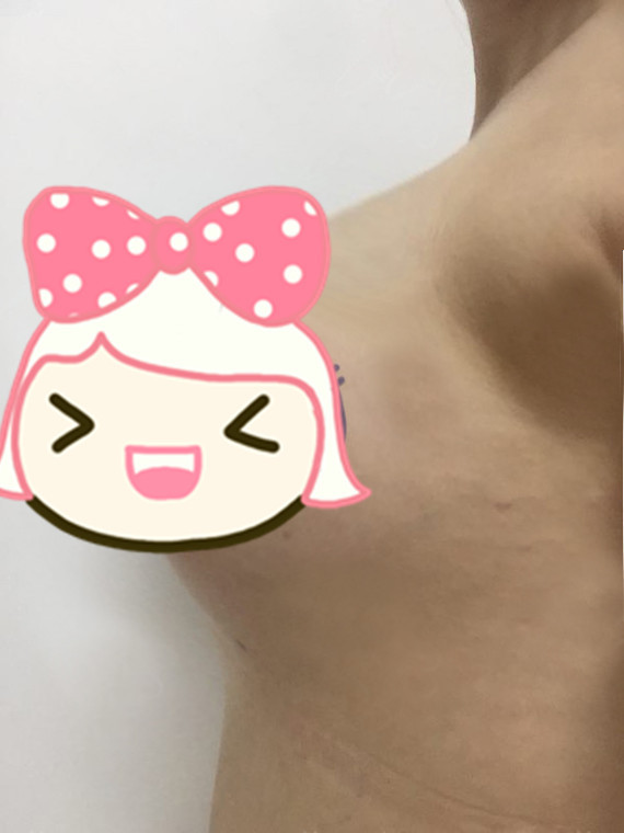 假体隆胸第1天