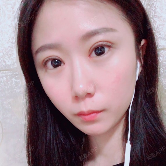 半个月了,肿已经彻底消了,最重要的是切割双眼皮的地