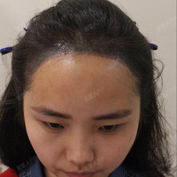 植发科普小知识